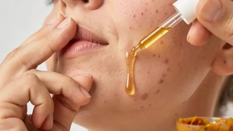 Como Clarear Manchas de Acne com um Plano de Ação que Funciona